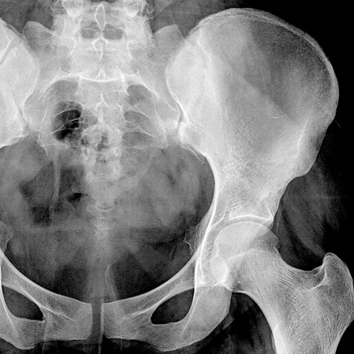 LEADING VIRTUAL OSTEOPOROSIS SPECIALISTS WARNS RESIDENTS