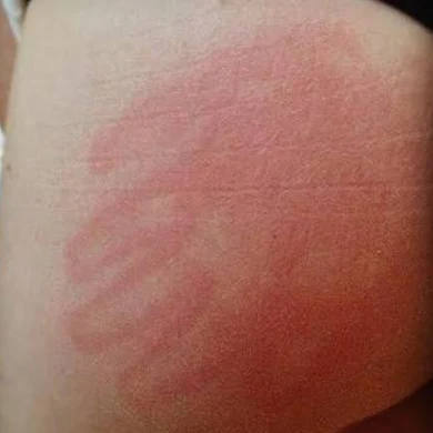 SKINCREDIBLE RELEASES SKIN GRAFTS TO RECTIFY MULTIPLE BUTT SLAPS
